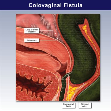 Colovaginal Fistula - TrialExhibits Inc.