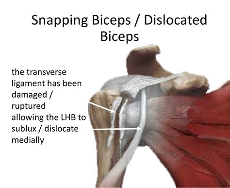 Long Head of Biceps - Cambridge Shoulder