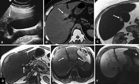 Focal sparing in fatty liver demonstrated in different subjects: Focal... | Download Scientific ...