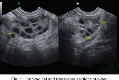 Figure 1 from Baseline Scan and Ultrasound Diagnosis of PCOS | Semantic ...