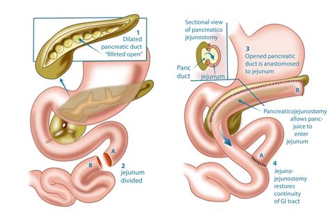 Pancreas Surgery, Pancreatectomy | Pancreas disorders specialist Perth