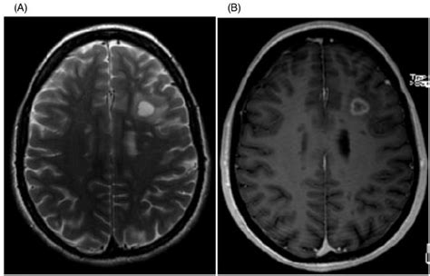 Ring-enhancing lesions: axial T2-weighted image showing a rim lesion... | Download Scientific ...