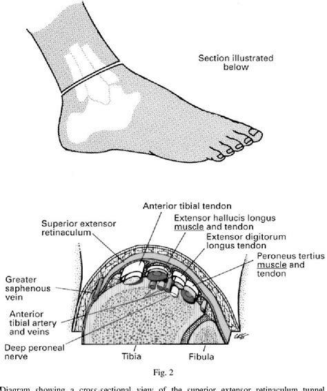 Figure 3 from Extensor retinaculum syndrome of the ankle after injury ...