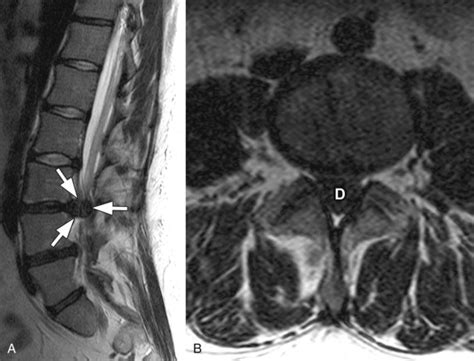 Cauda Equina Syndrome | Radiology Key