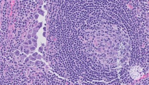 Extracavitary Primary Effusion Lymphoma-H&E High Power