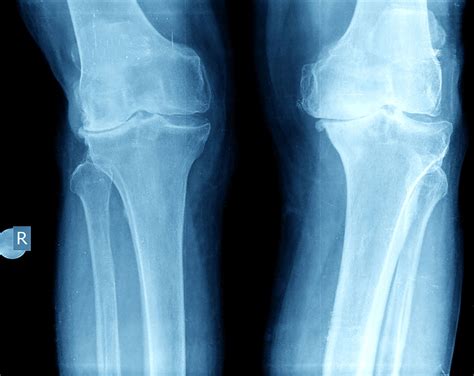 Running: Can it damage your knee? | Dr. David Geier - Sports Medicine ...
