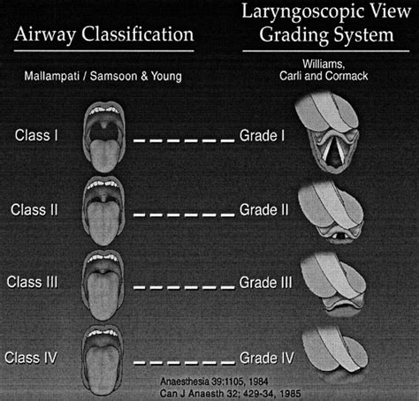 Mallampati score | Copd treatment, Nursing notes, Nurse anesthesia