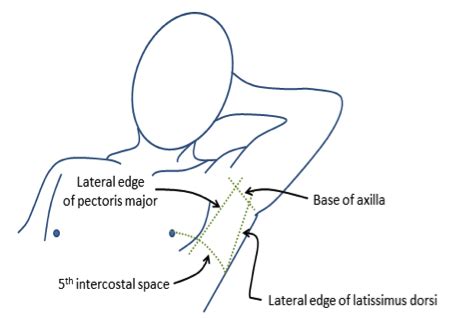 Chest Tube Insertion or Tube Thoracostomy | Epomedicine