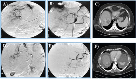 Figure 10, [Trans-arterial chemoembolization of the liver...]. - Liver Cancer - NCBI Bookshelf