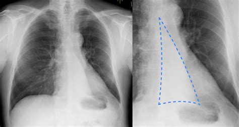 Left lower lobe collapse - CXR - Radiology at St. Vincent's University ...