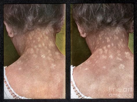 Rash Caused By Syphilis, Vintage Photograph by DoubleVision