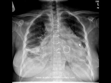 Heart Valve: Artificial Heart Valve X Ray