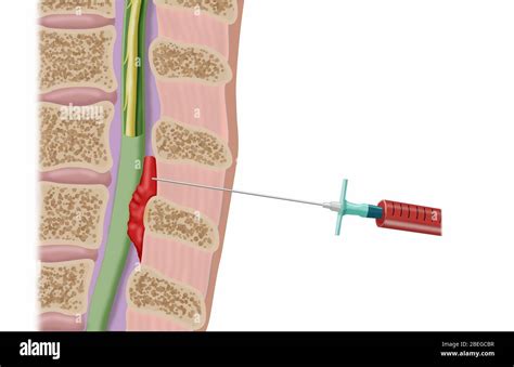 Epidural Blood Patch Procedure, Illustration Stock Photo - Alamy