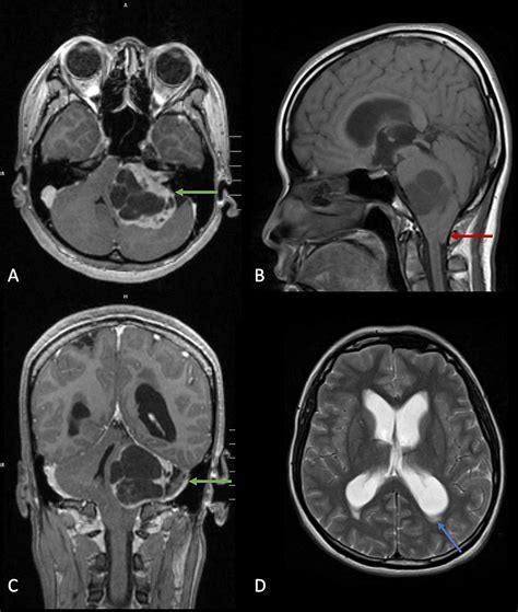 Cureus | False Localizing Trigeminal V2 Sensory Loss in Vestibular Schwannoma