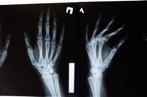 Here’s Why You Should Get Your Hand Fractures Treated Quickly - Able Hands Rehabilitation