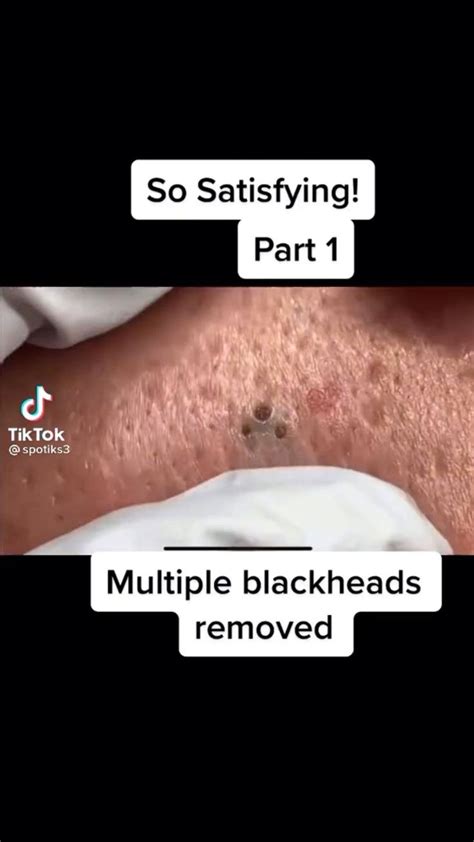 Blackheads removal satisfying | Blackheads, Zits, Acne