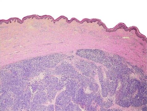 Merkel Cell Carcinoma Histology / Merkel Cell Carcinoma Treatment Pdq Health Professional ...