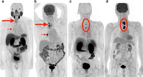 Patients with metastatic thyroid cancer with greater FDG uptake than... | Download Scientific ...