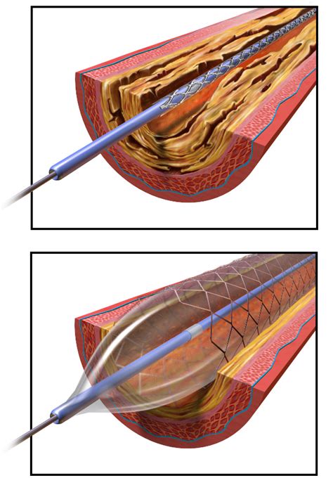 Angioplasty - Wikiwand