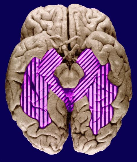 Parahippocampal Gyrus (diagonal stripes) and Fusiform Gyrus (vertical stripes) (With images ...