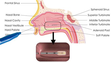 turbinate-reduction - Fort Worth ENT & Sinus