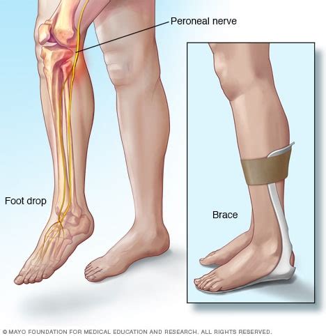 Foot drop - Diagnosis and treatment - Mayo Clinic