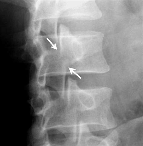 Learning Radiology - Spondylolysis