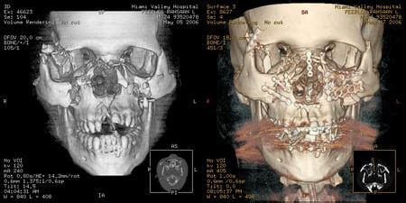 Dental Trauma Dayton Ohio | Facial Trauma Springboro & Beavercreek