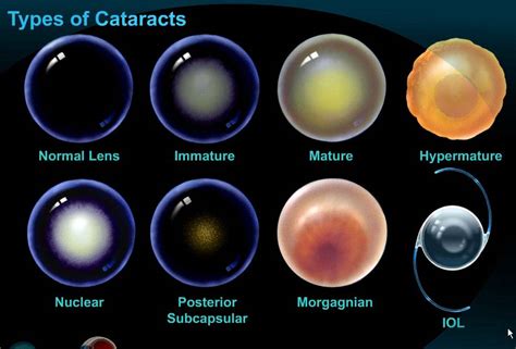 Cataracts Types