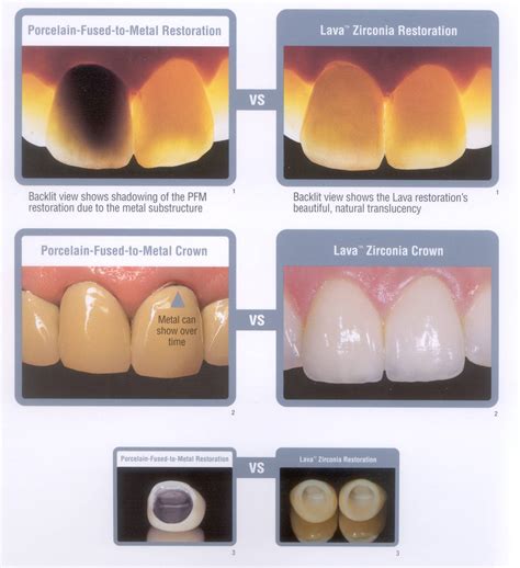 Zirconia Crowns Before And After | Dr. Ari Greenspan Dentist