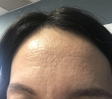 Texture on Forehead - General acne discussion - Acne.org