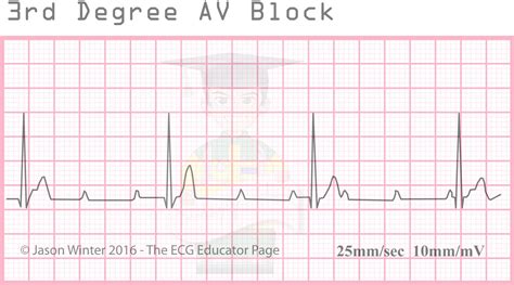 3rd Degree Heart Block - Photos Idea