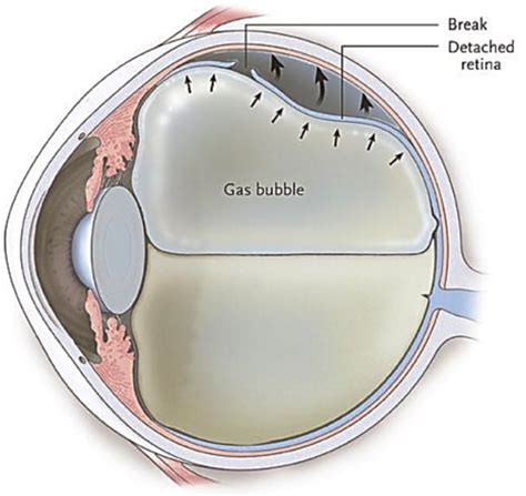 Conjunctivitis, Corneal Abrasion, Diabetic retinopathy, Retinal Detachment, Glaucoma, Bell's ...