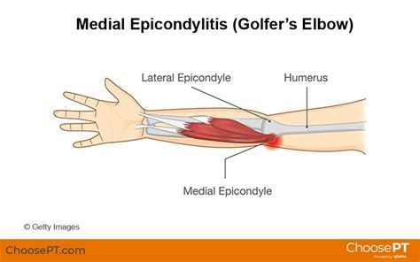 Guide | Physical Therapy Guide to Golfer's Elbow (Medial Epicondylitis) | Choose PT