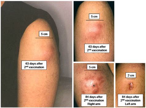 Case report of local reaction and sterile abscess formation. Two days... | Download Scientific ...