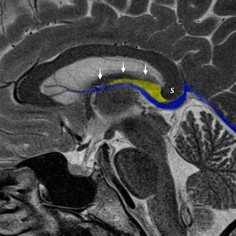 The velum interpositum (yellow) is formed by an invagination of pia matter forming a triangular ...