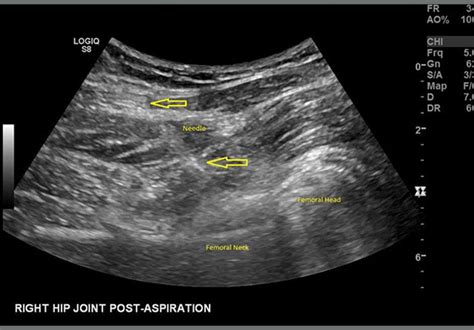 Success with ultrasound-guided aspirations of hip arthroplasties - Mayo ...