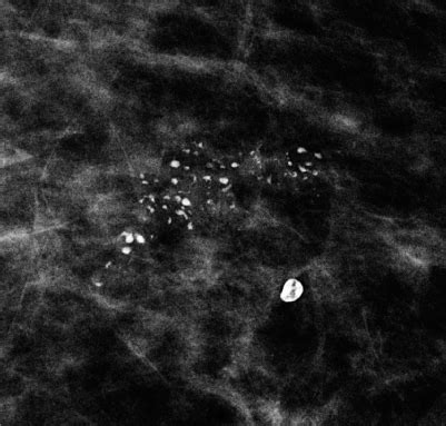 How to Interpret Microcalcifications | Abdominal Key