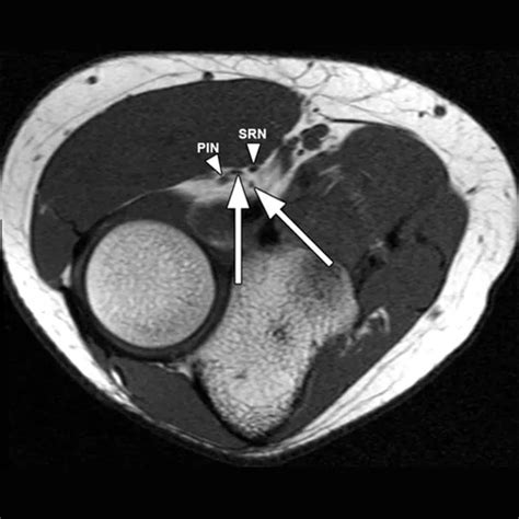 MRI Left Median Nerve | Test Price in Delhi | Ganesh Diagnostic