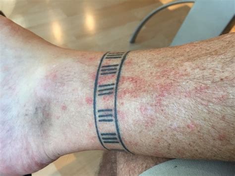 Hiker's rash: red rash between knee and ankle after hiking for several hours