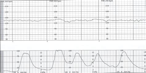 Tachysystole Definition, Contractions, CTG, Labor, Treatment, ICD-10 ...