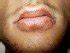 Tongue Discoloration (White, Red, Purple, Blue, Yellow, Black ...