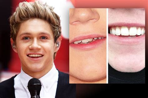 Niall Horan from One Direction gets his braces off and reveals straight ...