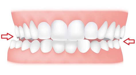 Crossbite Definition, Types, Causes & Treatment - Healthrow.net