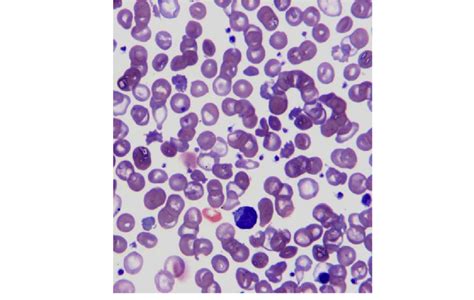 Figure1: Patient's peripheral blood smear: many Schistocytes,... | Download Scientific Diagram