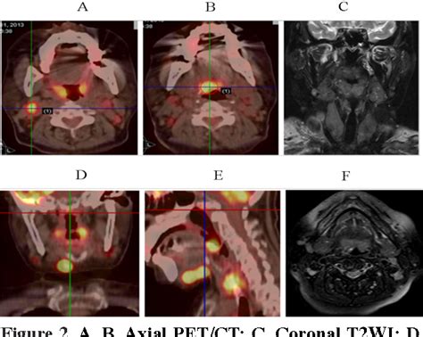 Figure 1 from Imaging Anatomy of Waldeyer's Ring and PET/CT and MRI ...