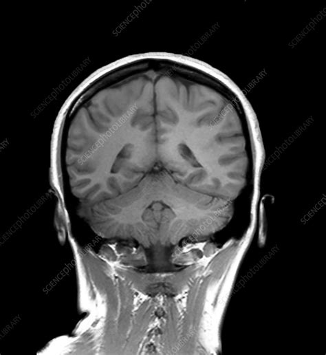 Healthy brain, MRI scan - Stock Image - C049/9310 - Science Photo Library