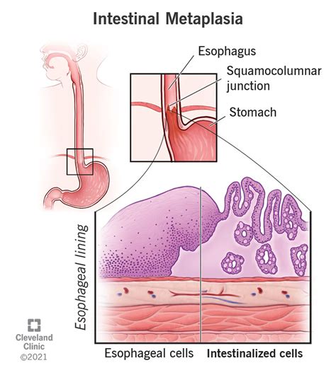 Metaplasia: What Is It, Types, Causes, And More Osmosis, 59% OFF