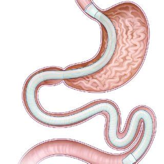 Duodenal-jejunal bypass liner. | Download Scientific Diagram