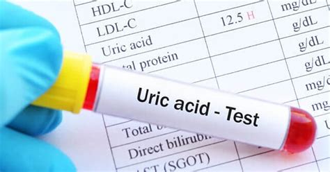 What is hyperuricemia? Learn the causes, symptoms, diagnosis and treatment